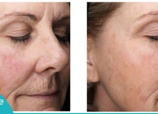 მოიშორეთ ნაოჭები, ზედმეტი ცხიმები და გაიღიავეთ სახის კანი სულ რაღაც 1 კვირაში!