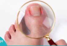 როგორ უნდა უმკურნალოთ ჩაბრუნებულ ფრჩხილს? სასარგებლო და ეფექტური რჩევები