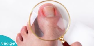 როგორ უნდა უმკურნალოთ ჩაბრუნებულ ფრჩხილს? სასარგებლო და ეფექტური რჩევები