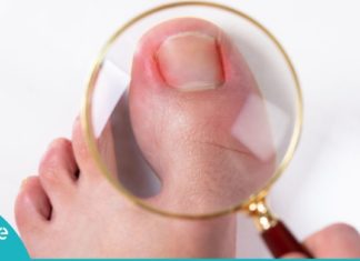 როგორ უნდა უმკურნალოთ ჩაბრუნებულ ფრჩხილს? სასარგებლო და ეფექტური რჩევები