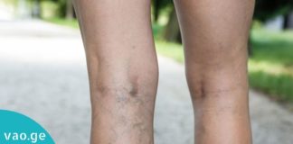 როგორ ვუმკურნალოთ ვარიკოზულ ვენებს სახლის პირობებში? საინტერესოა…