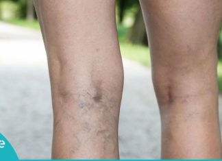 როგორ ვუმკურნალოთ ვარიკოზულ ვენებს სახლის პირობებში? საინტერესოა…