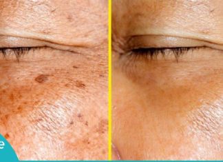 პიგმენტური ლაქების მოსაშორებელი ოთხი ეფექტური ნიღაბი პროფესიონალი კოსმეტოლოგის რჩევით