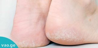 ეს მარტივი და ეფექტური მეთოდი დამსკდარ და უხეშ ქუსლებს სამუდამოდ დაგავიწყებთ!