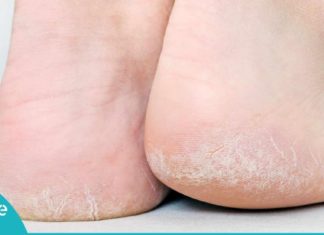 ეს მარტივი და ეფექტური მეთოდი დამსკდარ და უხეშ ქუსლებს სამუდამოდ დაგავიწყებთ!