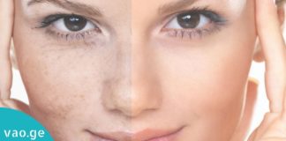 პიგმენტური ლაქების მოსაშორებელი ოთხი ყველაზე კარგი ნიღაბი პროფესიონალი კოსმეტოლოგისგან!