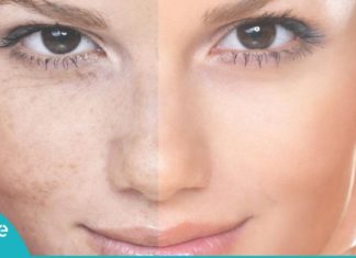 პიგმენტური ლაქების მოსაშორებელი ოთხი ყველაზე კარგი ნიღაბი პროფესიონალი კოსმეტოლოგისგან!