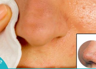 ამ მარტივი რეცეპტის საშუალებით ფერიმჭამელებისგან მყისვე გათავისუფლდებით. ეფექტურია