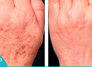 ექვსი სუპერ-რეცეპტი პიგმენტურ ლაქებთან ბრძოლისათვის. დაუჯერებელი ეფექტი