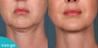 საშუალება, რომელიც კისრის კანს ელასტიურს გახდის. ეს ყველა მანდილოსანს გამოადგება!