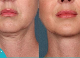 საშუალება, რომელიც კისრის კანს ელასტიურს გახდის. ეს ყველა მანდილოსანს გამოადგება!