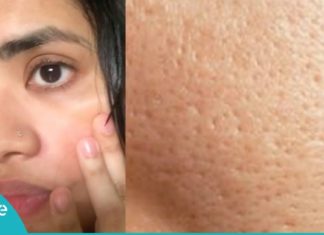 ინგრედიენტი, რომელიც სახის ღია ფორებს შველის. ყველაზე ეფექტური მეთოდი