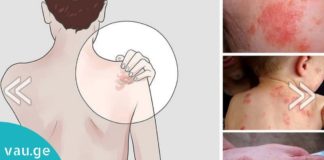 ეგზემის მკურნალობის 7 სტრატეგია-შეწყვიტეთ აბების მიღება და სცადეთ ეს!