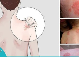 ეგზემის მკურნალობის 7 სტრატეგია-შეწყვიტეთ აბების მიღება და სცადეთ ეს!