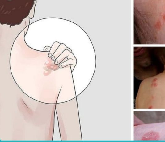 ეგზემის მკურნალობის 7 სტრატეგია-შეწყვიტეთ აბების მიღება და სცადეთ ეს!