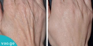 საოცარი კრემი ხელებზე დამსკდარი კანის წინააღმდეგ. შედეგი ყველას გააოცებს!
