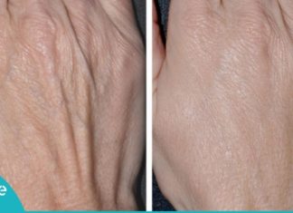 საოცარი კრემი ხელებზე დამსკდარი კანის წინააღმდეგ. შედეგი ყველას გააოცებს!