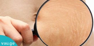 5 ნატურალური მკურნალი სტრიების მოსაშორებლად! ეფექტურია…