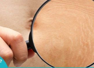 5 ნატურალური მკურნალი სტრიების მოსაშორებლად! ეფექტურია…