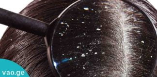 ქერტლის საწინააღმდეგო სასწაულმოქმედი საშუალება. საიდუმლო მხოლოდ 1 ინგრედიენტშია