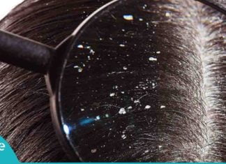 ქერტლის საწინააღმდეგო სასწაულმოქმედი საშუალება. საიდუმლო მხოლოდ 1 ინგრედიენტშია