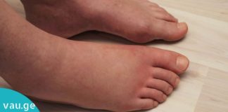 ეს ყველაზე იაფი და ეფექტური საშუალებაა ფეხების შეშუპების წინააღმდეგ!