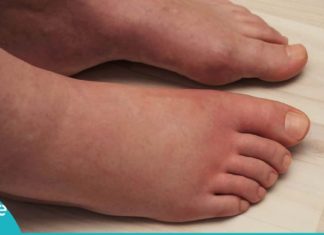 ეს ყველაზე იაფი და ეფექტური საშუალებაა ფეხების შეშუპების წინააღმდეგ!