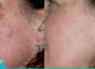 პიგმენტური ლაქები ამ რეცეპტების წინააღმდეგ უძლურნი არიან, შედეგი – 100%-ით სუფთა სახე !