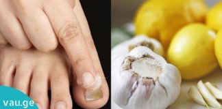 ფრჩხილის სოკოს მკურნალობა ნიორის და ლიმონის საშუალებით. მარტივი და ეფექტურია