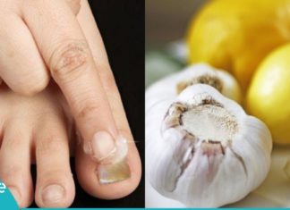 ფრჩხილის სოკოს მკურნალობა ნიორის და ლიმონის საშუალებით. მარტივი და ეფექტურია