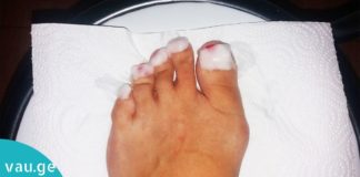 ასე მოვიშორე ფეხის სოკო სამუდამოდ. ამაში კი მხოლოდ ერთი ინგრედიენტი დამეხმარა