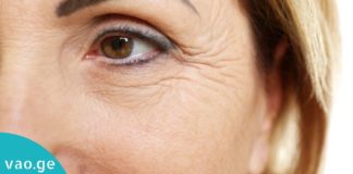 როგორ მოვიშოროთ თვალების კუთხეებში გაჩენილი ნაოჭები? ყველაზე სწრაფი მეთოდები