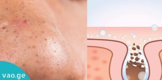 ამ ორი ნატურალური ინგრედიენტის გამოყენებით შავი წერტილებისგან სამუდამოდ გათავისუფლდებით