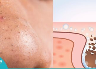 ამ ორი ნატურალური ინგრედიენტის გამოყენებით შავი წერტილებისგან სამუდამოდ გათავისუფლდებით