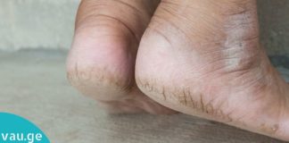 რით ვუშველოთ დამსკდარ ქუსლებს? ხერხი, რომლის შედეგს რამდენიმე წუთში ნახავთ