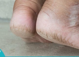 რით ვუშველოთ დამსკდარ ქუსლებს? ხერხი, რომლის შედეგს რამდენიმე წუთში ნახავთ