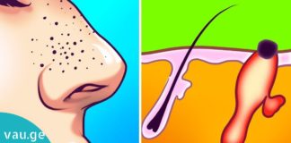 ამ უმარტივესი და ეფექტური ნიღბების დახმარებით, შავ წერტილებს სამუდამოდ მოიშორებთ!