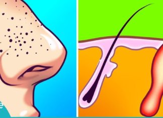 ამ უმარტივესი და ეფექტური ნიღბების დახმარებით, შავ წერტილებს სამუდამოდ მოიშორებთ!