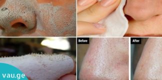 საუკეთესო საშუალება შავი წერტილების მოსაშორებლად. ნიღაბი თქვენი სილამაზისთვის