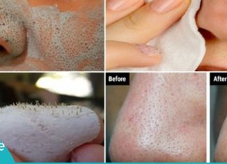 საუკეთესო საშუალება შავი წერტილების მოსაშორებლად. ნიღაბი თქვენი სილამაზისთვის