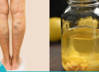 შეიზილეთ ეს ნარევი კანში და დაემშვიდობეთ ვარიკოზულ ვენებს