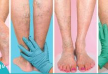 როგორ ვუმკურნალოთ ვენებს? ხალხური მეთოდები, რომელიც ბევრის თქმით ძალიან ეფექტურია!