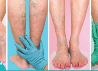 როგორ ვუმკურნალოთ ვენებს? ხალხური მეთოდები, რომელიც ბევრის თქმით ძალიან ეფექტურია!