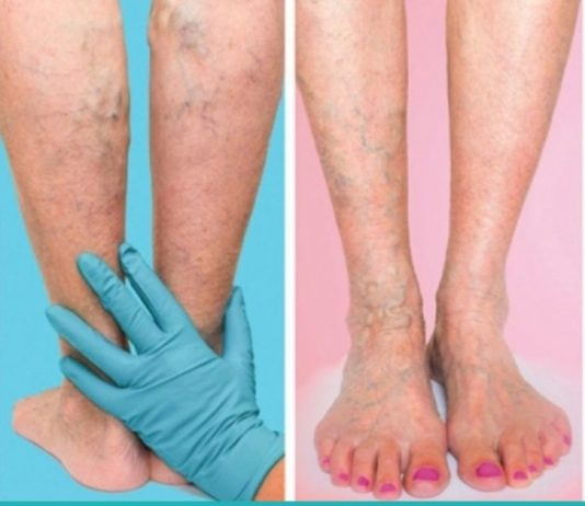 როგორ ვუმკურნალოთ ვენებს? ხალხური მეთოდები, რომელიც ბევრის თქმით ძალიან ეფექტურია!