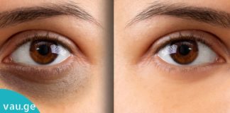 როგორ მოვიშოროთ შავი წრეები თვალების გარშემო? 3 ყველაზე ეფექტური ხერხი