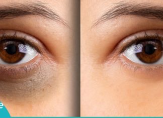 როგორ მოვიშოროთ შავი წრეები თვალების გარშემო? 3 ყველაზე ეფექტური ხერხი