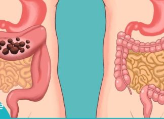 გაიგეთ, როგორ უნდა გაიწმინდოთ ნაწლავები ტოქსინებისგან – საჭირო ინფორმაცია!