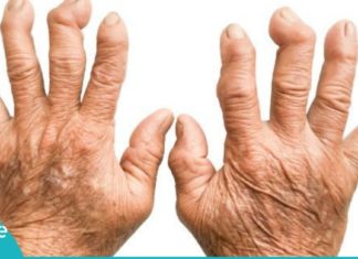 როგორ ვებრძოლოთ რევმატიზმს სახლის პირობებში? ეს საუკეთესო საშუალებაა