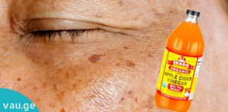 პიგმენტური ლაქებისგან ვაშლის ძმარი გაგათავისუფლებთ. შედეგი გაგაოცებთ