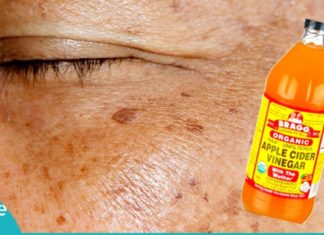 პიგმენტური ლაქებისგან ვაშლის ძმარი გაგათავისუფლებთ. შედეგი გაგაოცებთ